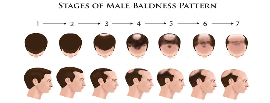  cure your baldness